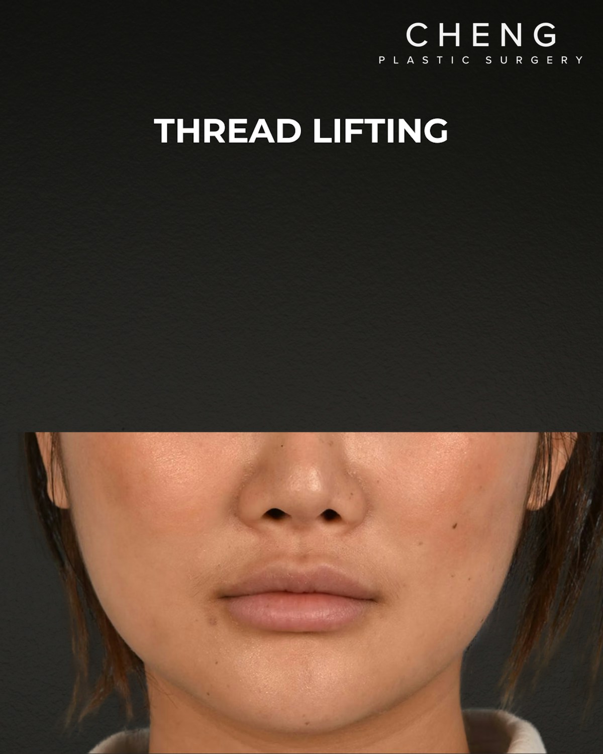 Thread Lifting Before & After Gallery - Patient 132694 - Image 2