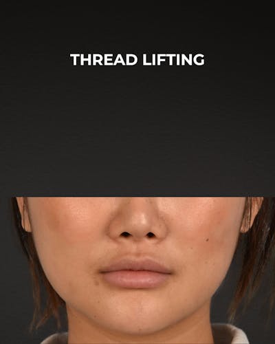 Thread Lifting Before & After Gallery - Patient 132694 - Image 2