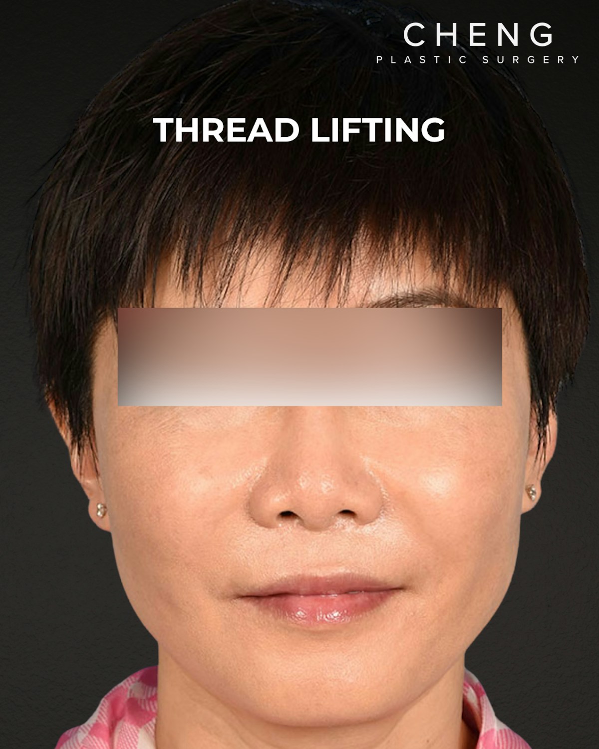 Thread Lifting Before & After Gallery - Patient 285819 - Image 2