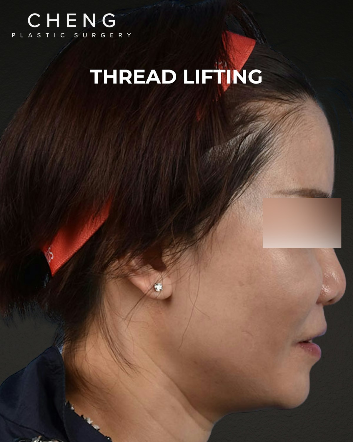 Thread Lifting Before & After Gallery - Patient 285819 - Image 3