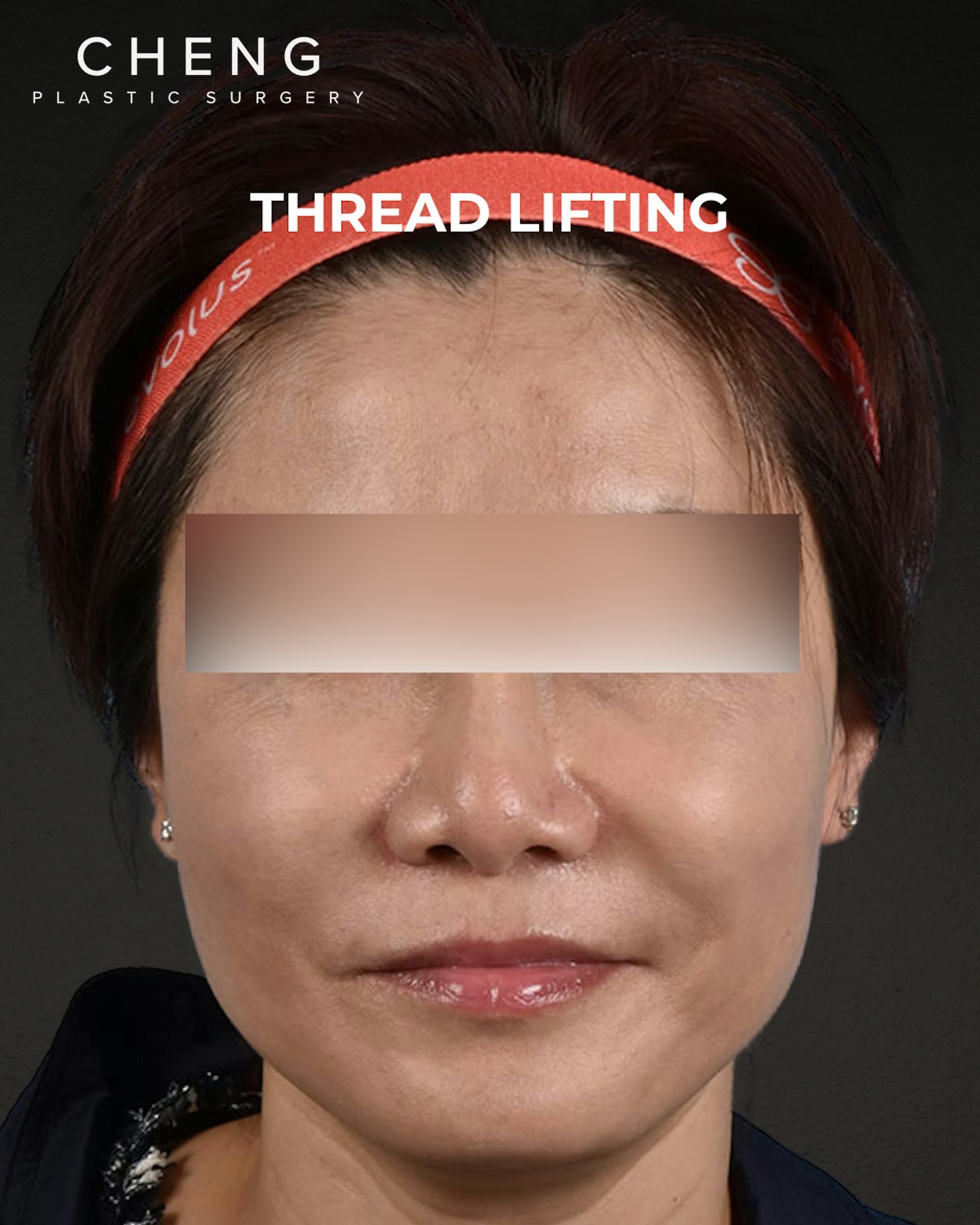 Thread Lifting Before & After Gallery - Patient 285819 - Image 1