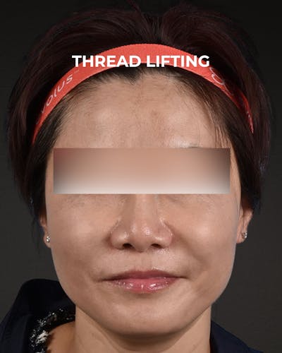 Thread Lifting Before & After Gallery - Patient 285819 - Image 1