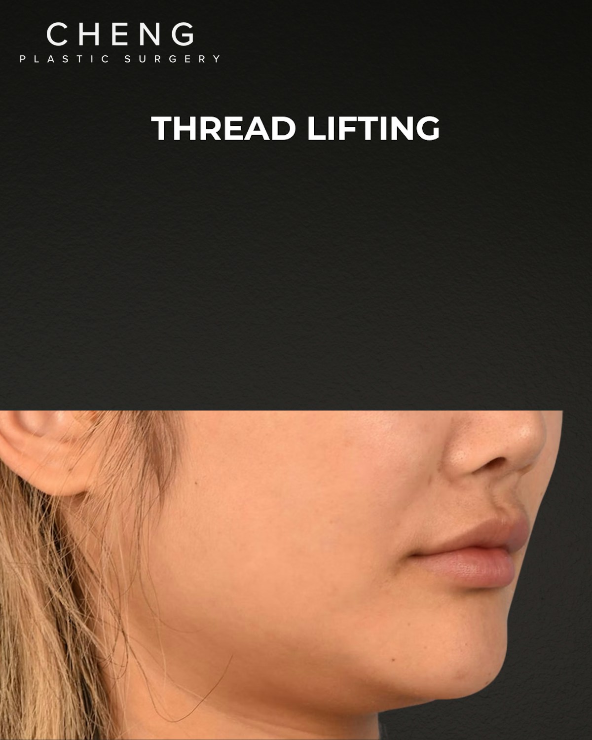 Thread Lifting Before & After Gallery - Patient 132694 - Image 3