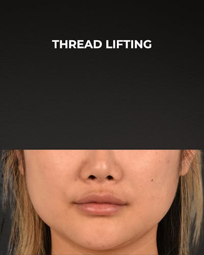 Thread Lifting Before & After Gallery - Patient 132694 - Image 1