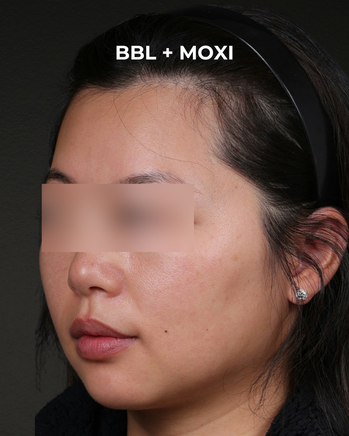 Pigment Laser Before & After Gallery - Patient 356417 - Image 4