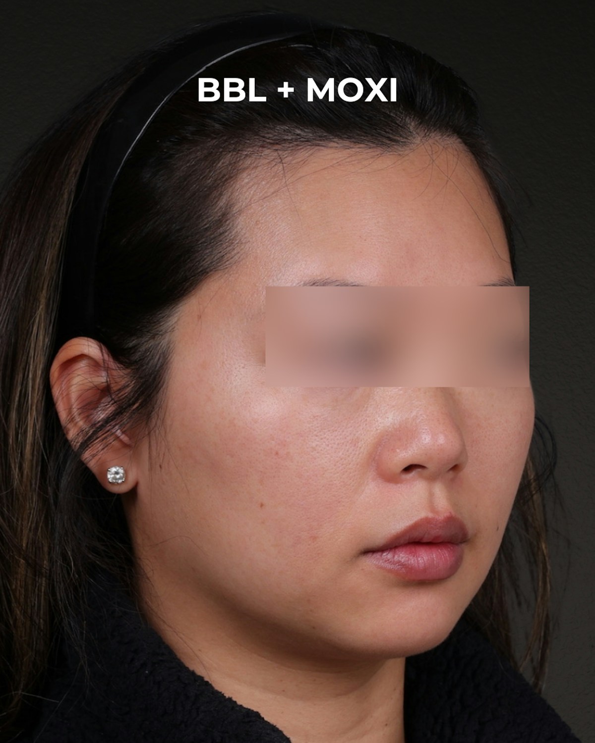 Pigment Laser Before & After Gallery - Patient 356417 - Image 6