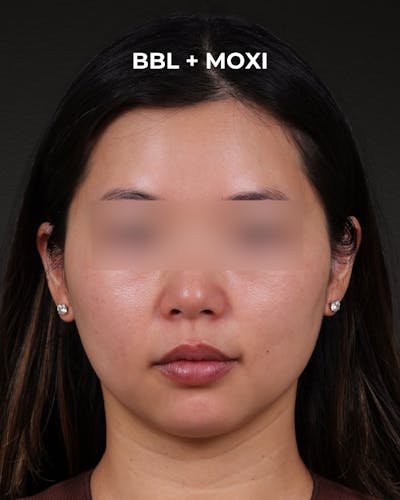 Pigment Laser Before & After Gallery - Patient 356417 - Image 2