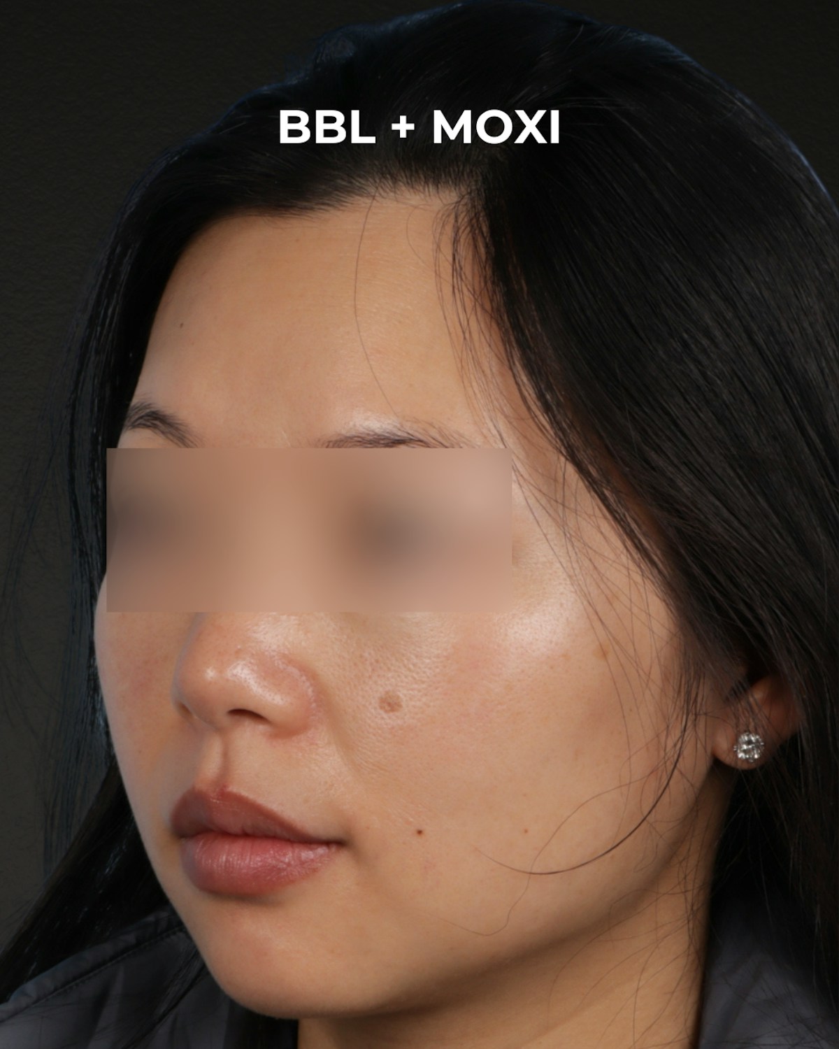 Pigment Laser Before & After Gallery - Patient 356417 - Image 3