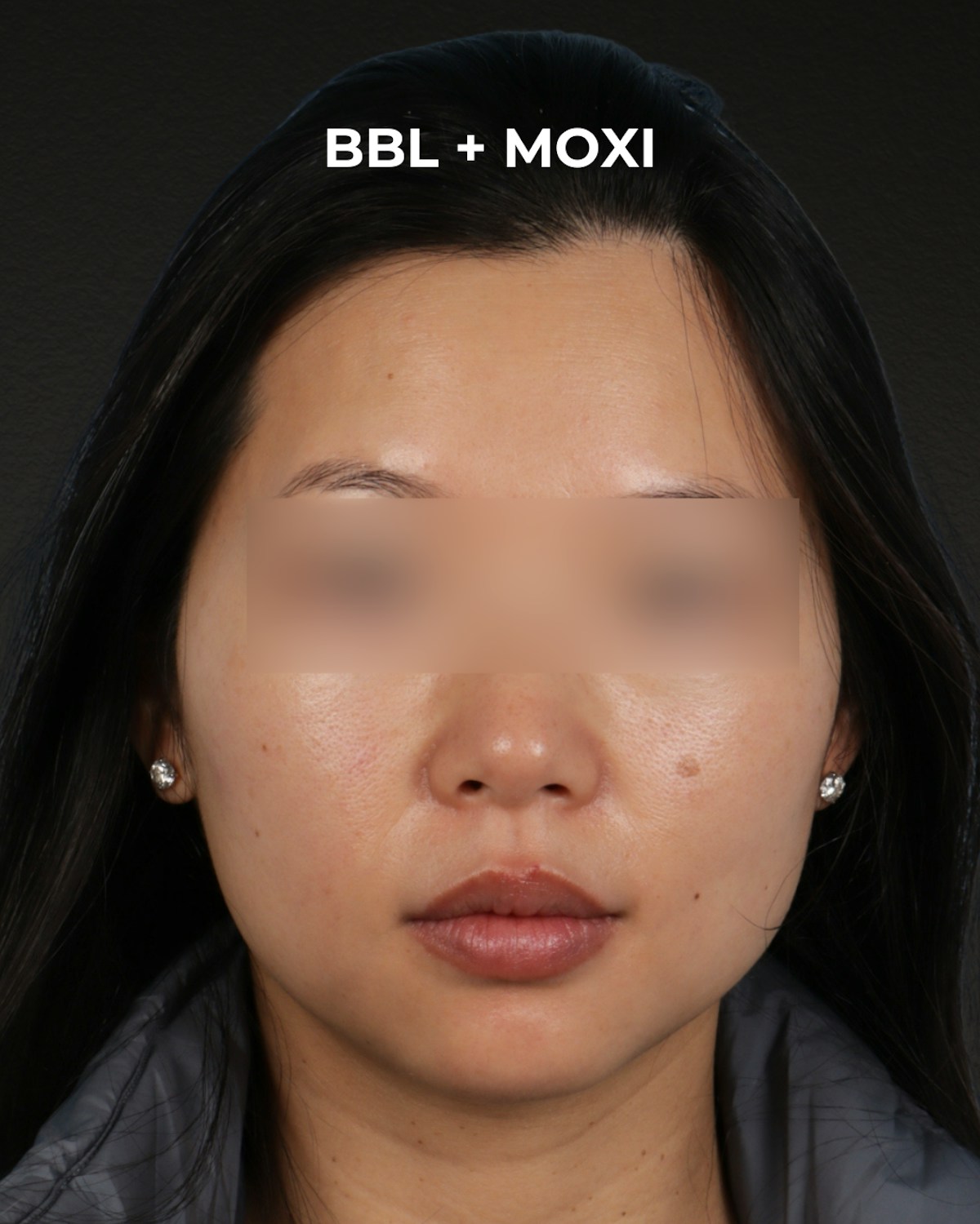 Pigment Laser Before & After Gallery - Patient 356417 - Image 1