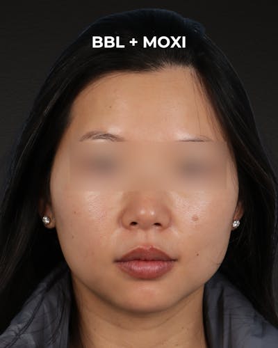 Pigment Laser Before & After Gallery - Patient 356417 - Image 1