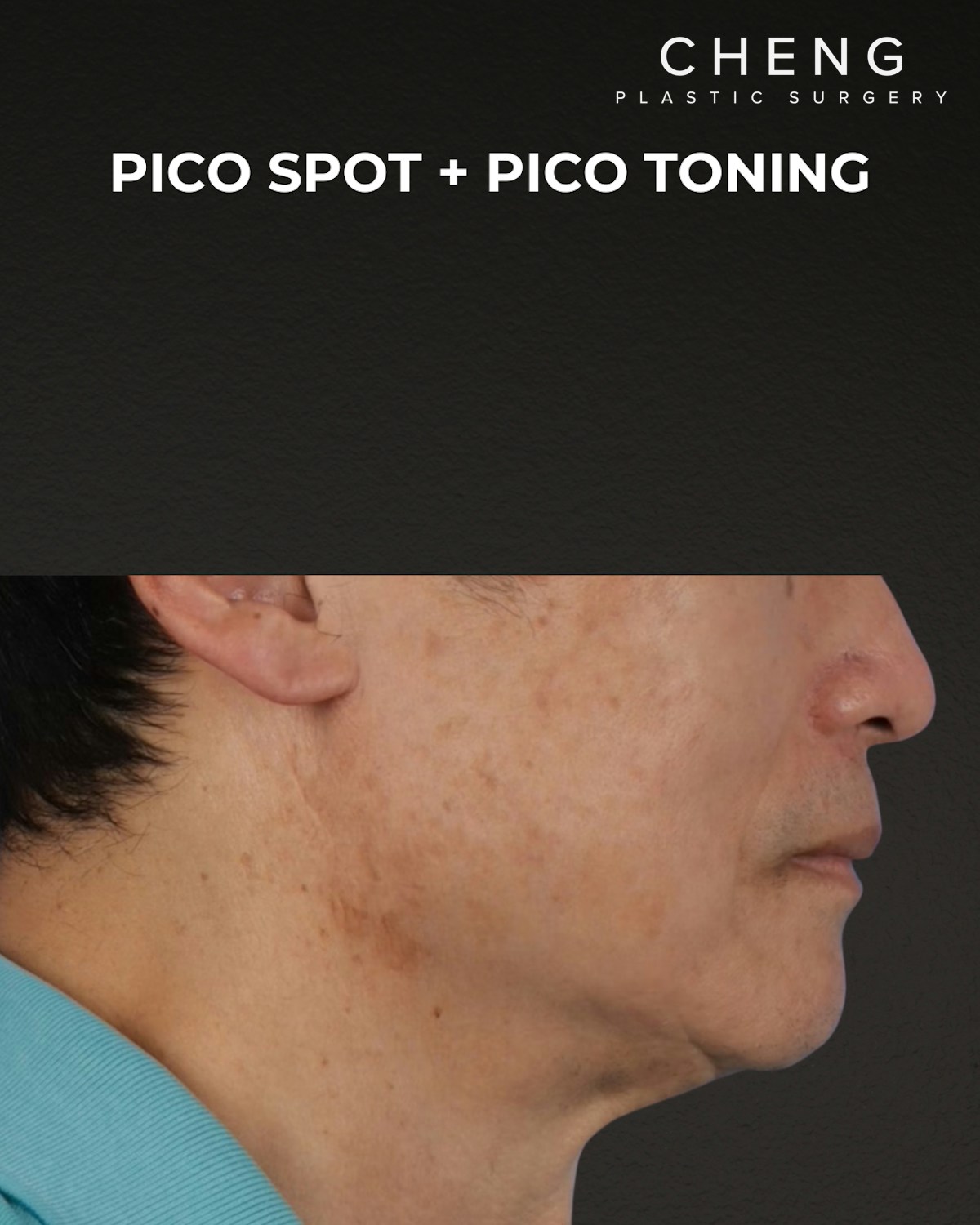 Pigment Laser Before & After Gallery - Patient 297186 - Image 4