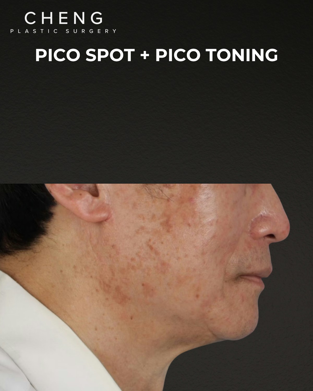 Pigment Laser Before & After Gallery - Patient 297186 - Image 3
