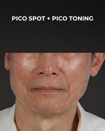 Pigment Laser Before & After Gallery - Patient 297186 - Image 1