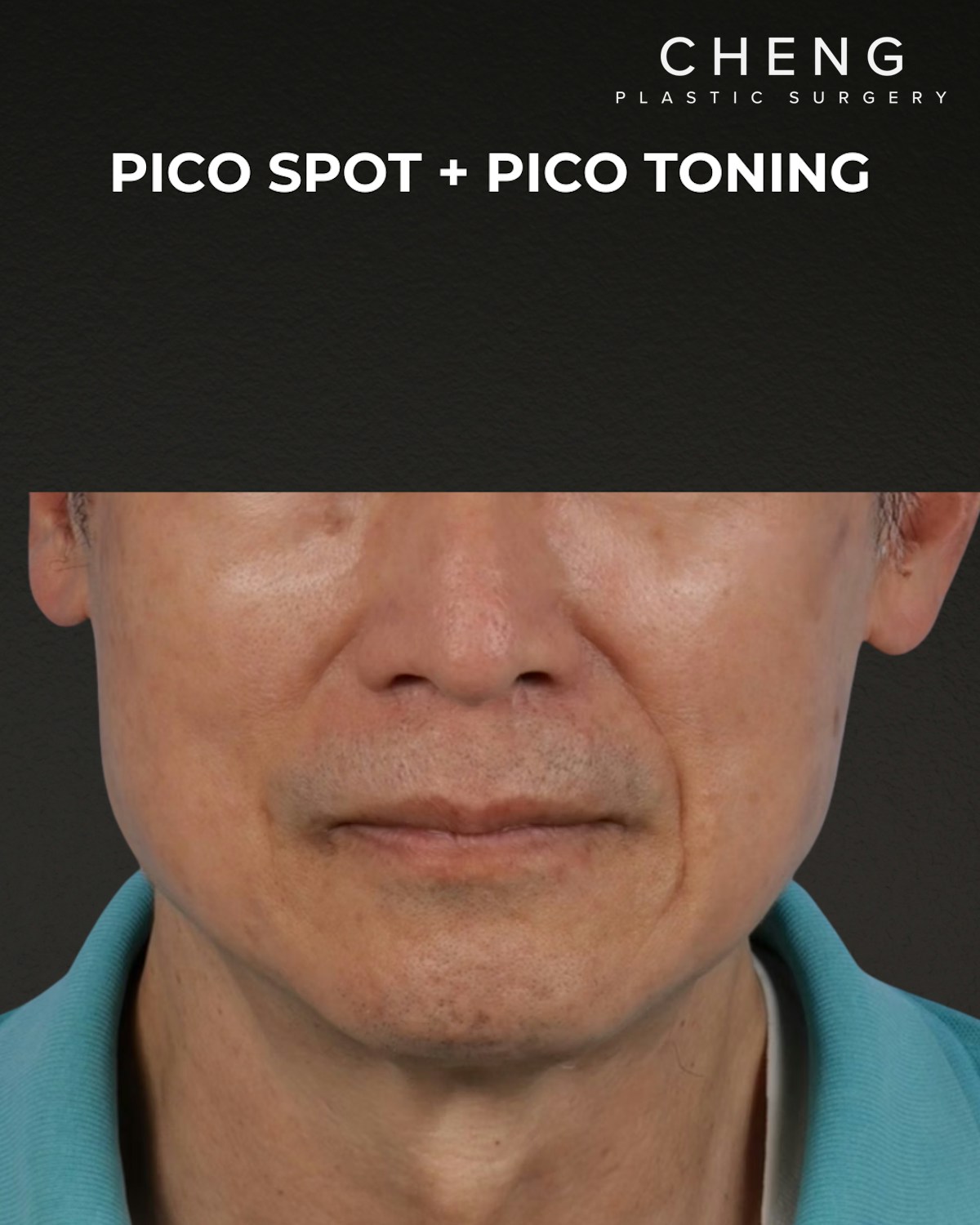 Pigment Laser Before & After Gallery - Patient 297186 - Image 2