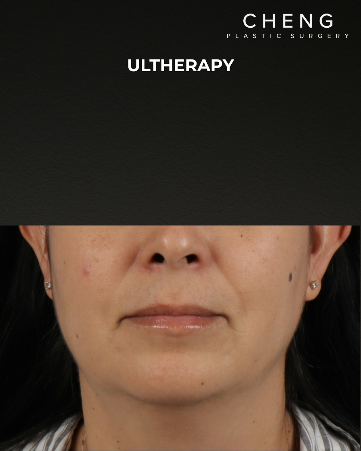 Ultherapy Before & After Gallery - Patient 385000 - Image 2