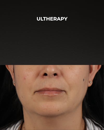 Ultherapy Before & After Gallery - Patient 385000 - Image 2