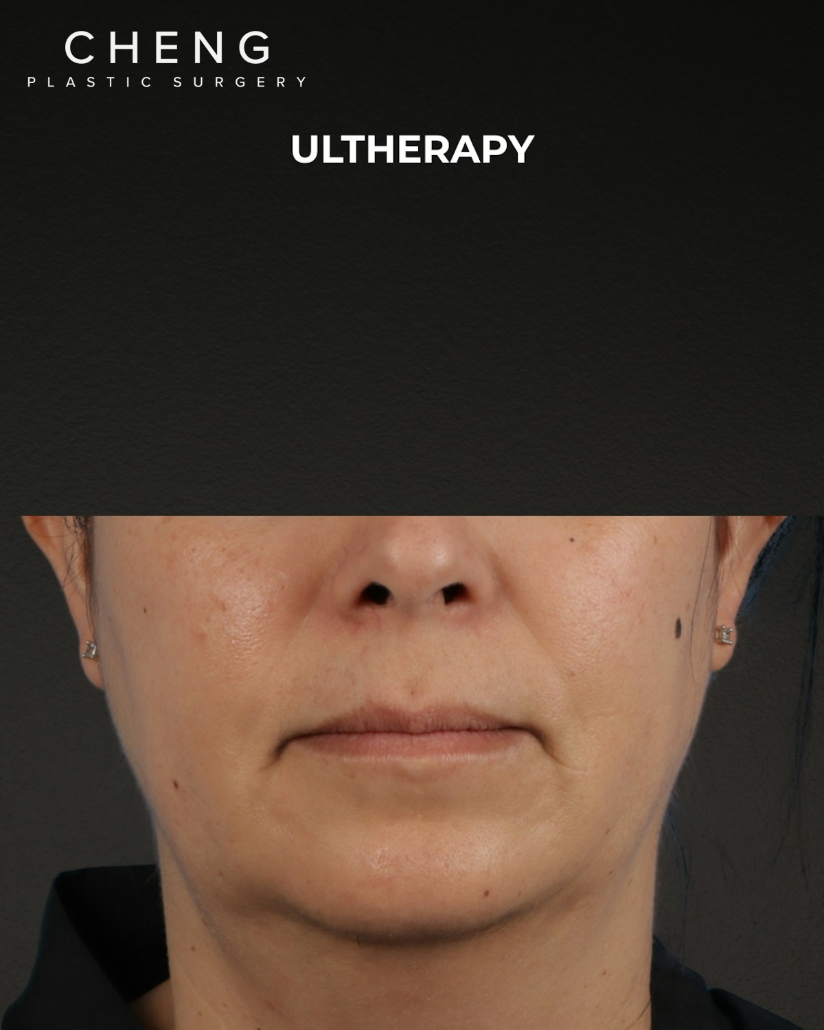 Ultherapy Before & After Gallery - Patient 385000 - Image 1