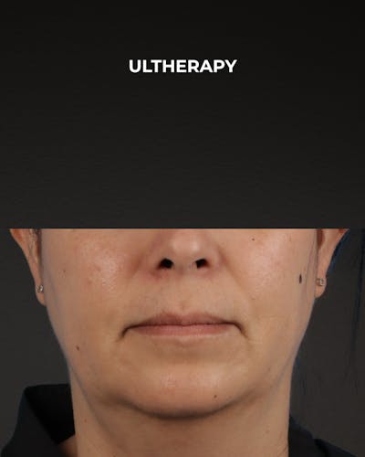 Ultherapy Before & After Gallery - Patient 385000 - Image 1