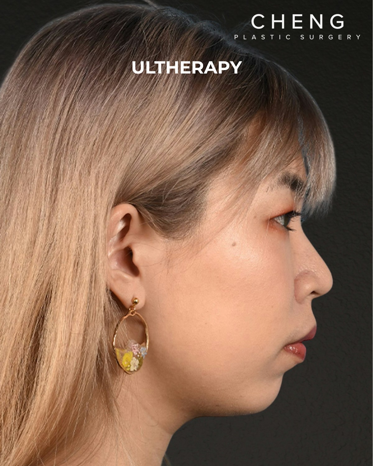 Ultherapy Before & After Gallery - Patient 103120 - Image 6