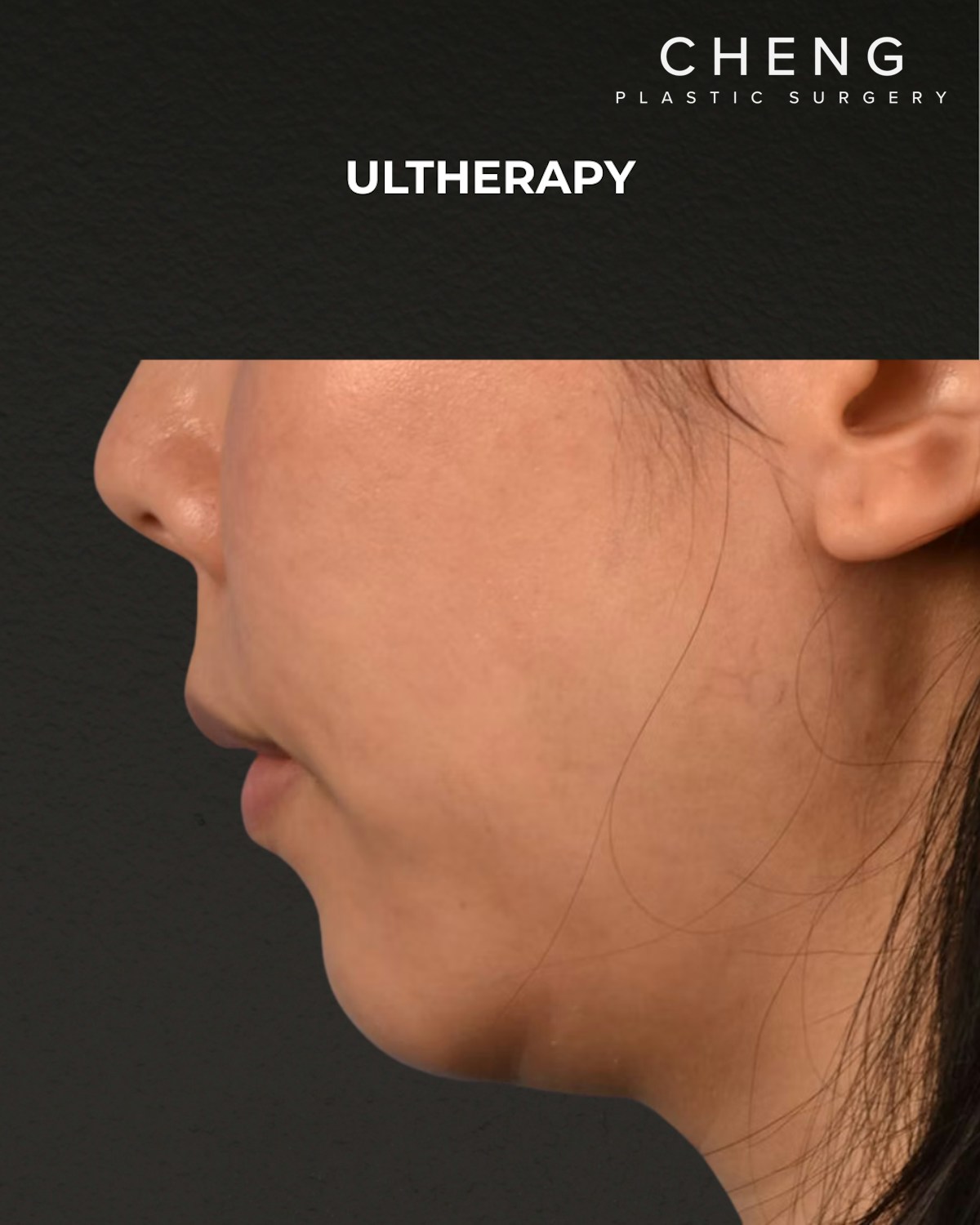 Ultherapy Before & After Gallery - Patient 134425 - Image 6
