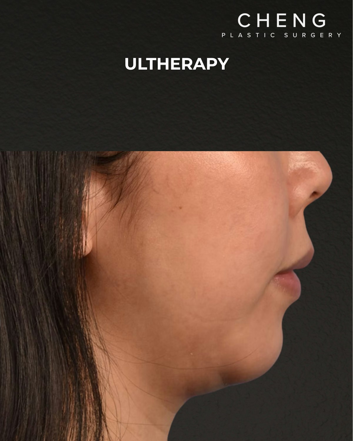Ultherapy Before & After Gallery - Patient 134425 - Image 8
