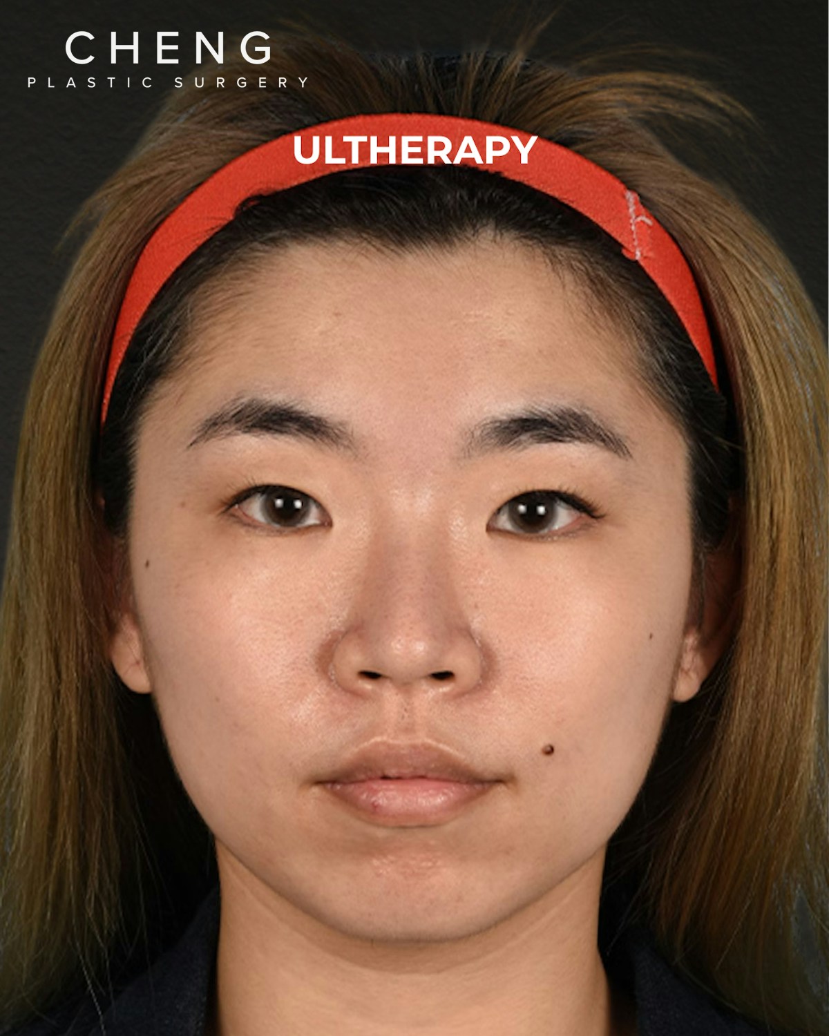 Ultherapy Before & After Gallery - Patient 103120 - Image 1
