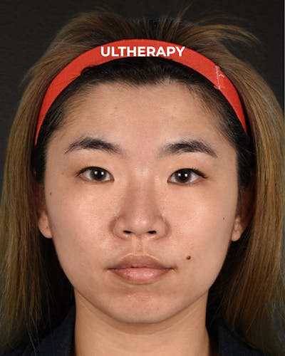 Ultherapy Before & After Gallery - Patient 103120 - Image 1