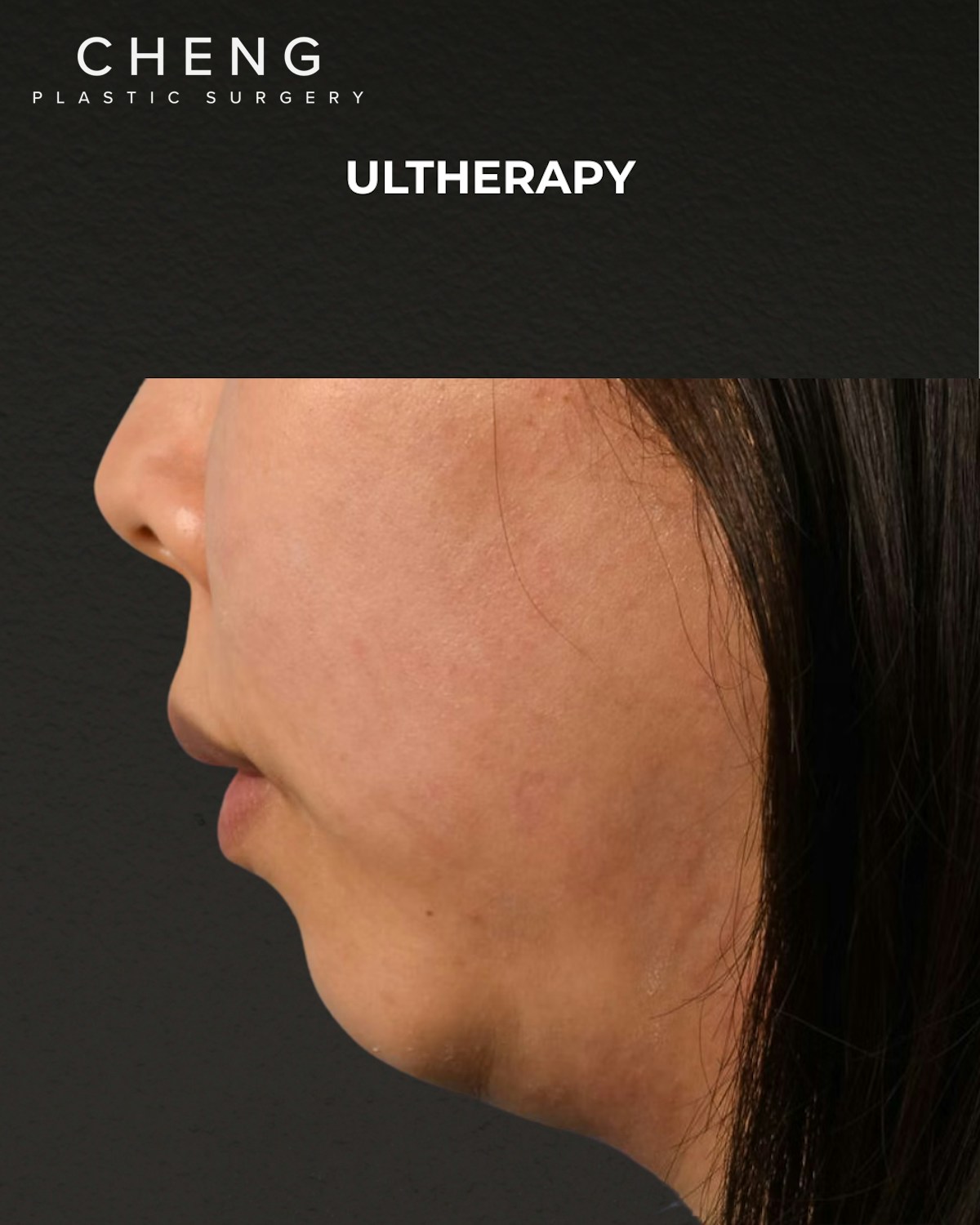 Ultherapy Before & After Gallery - Patient 134425 - Image 5