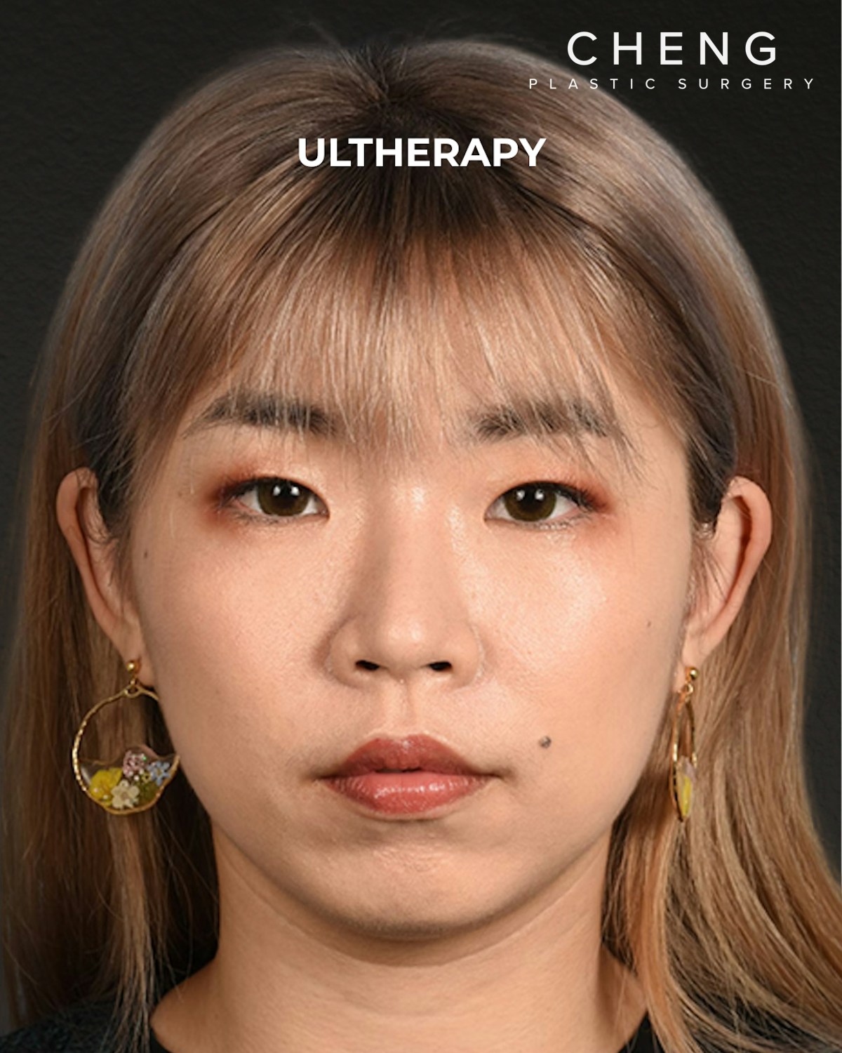 Ultherapy Before & After Gallery - Patient 103120 - Image 2