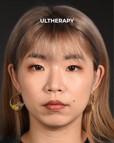 Ultherapy Before & After Gallery - Patient 103120 - Image 2