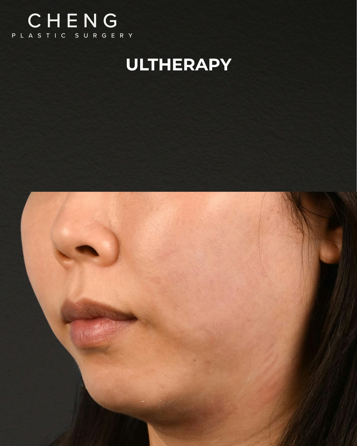 Ultherapy Before & After Gallery - Patient 134425 - Image 3