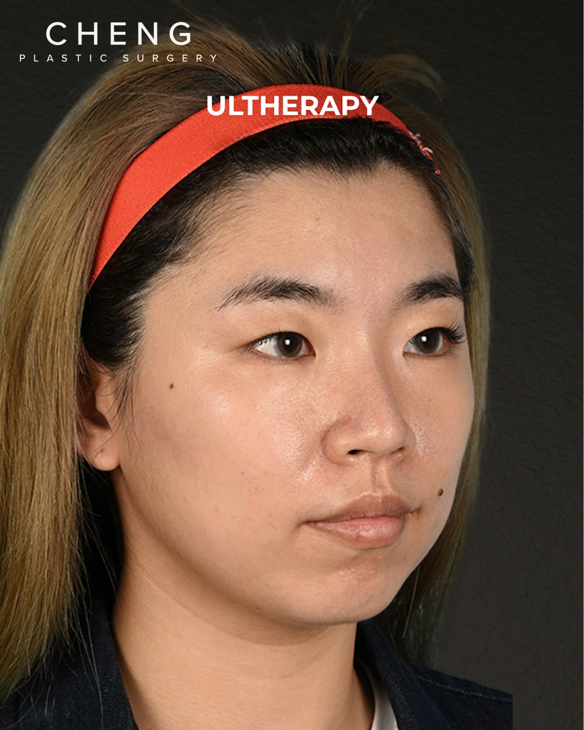 Ultherapy Before & After Gallery - Patient 103120 - Image 3