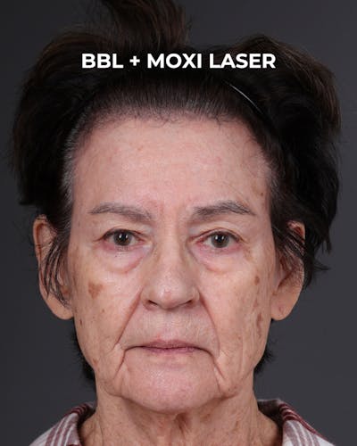Pigment Laser Before & After Gallery - Patient 182306 - Image 1