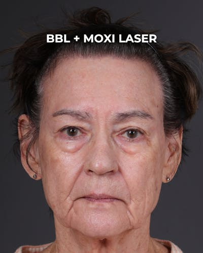 Pigment Laser Before & After Gallery - Patient 182306 - Image 2