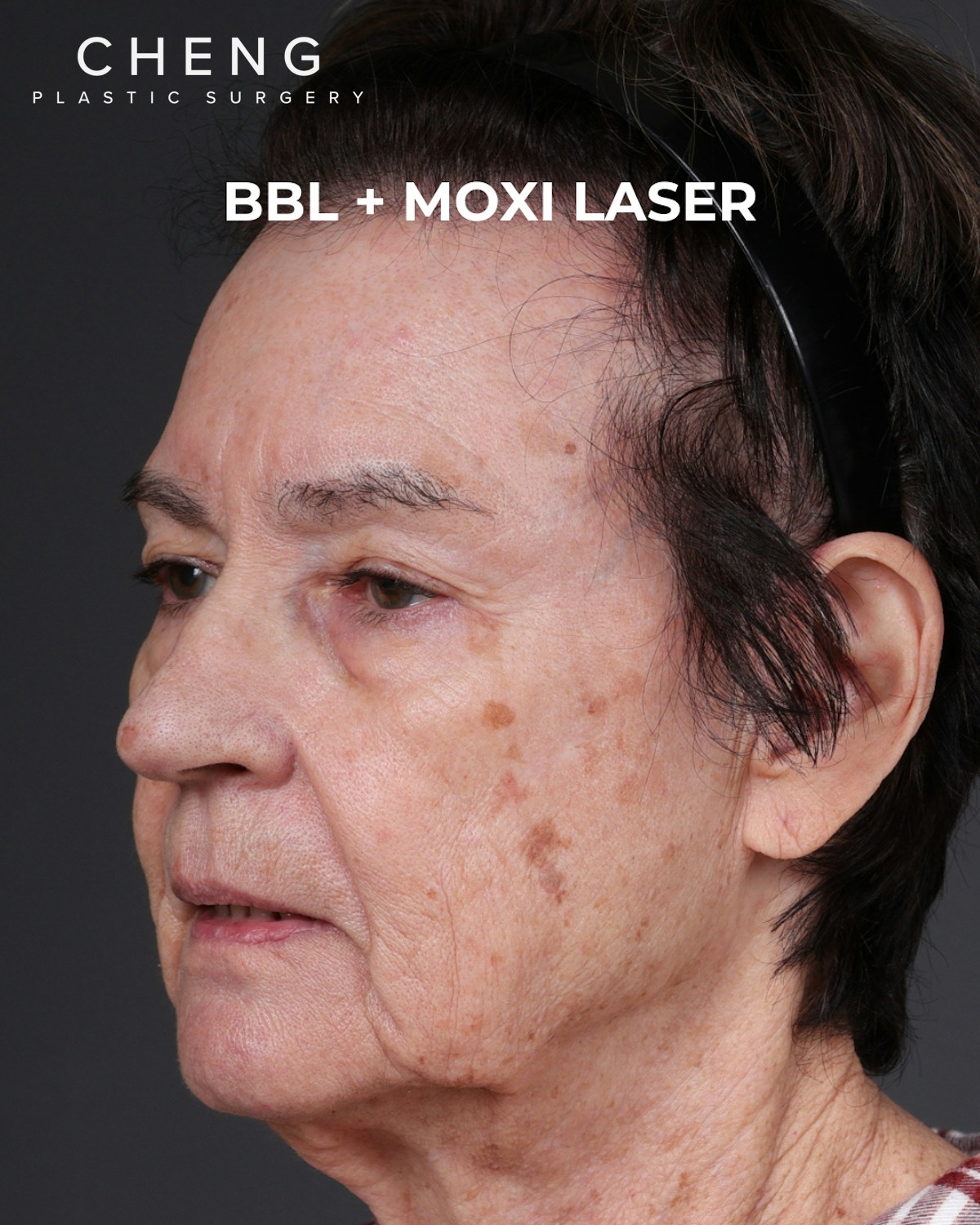 Pigment Laser Before & After Gallery - Patient 182306 - Image 3