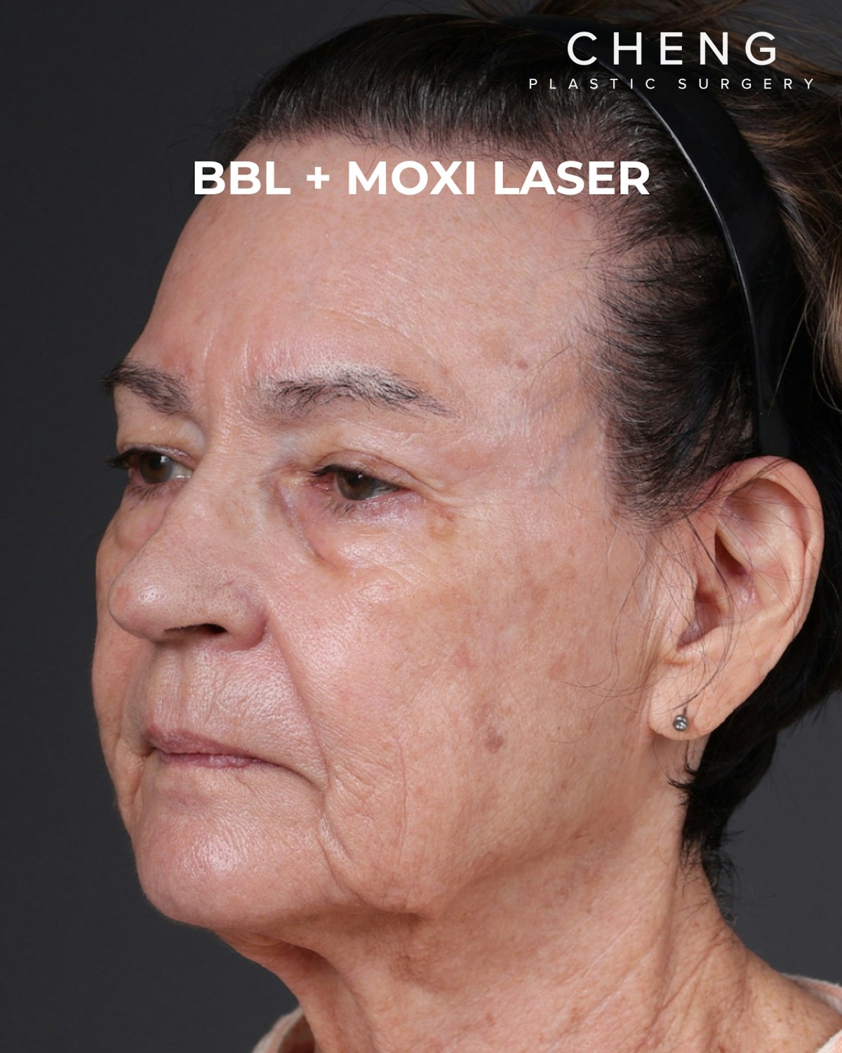 Pigment Laser Before & After Gallery - Patient 182306 - Image 4