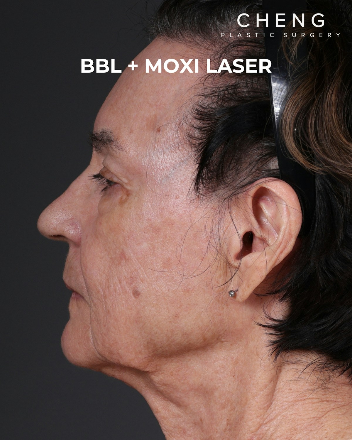 Pigment Laser Before & After Gallery - Patient 182306 - Image 6