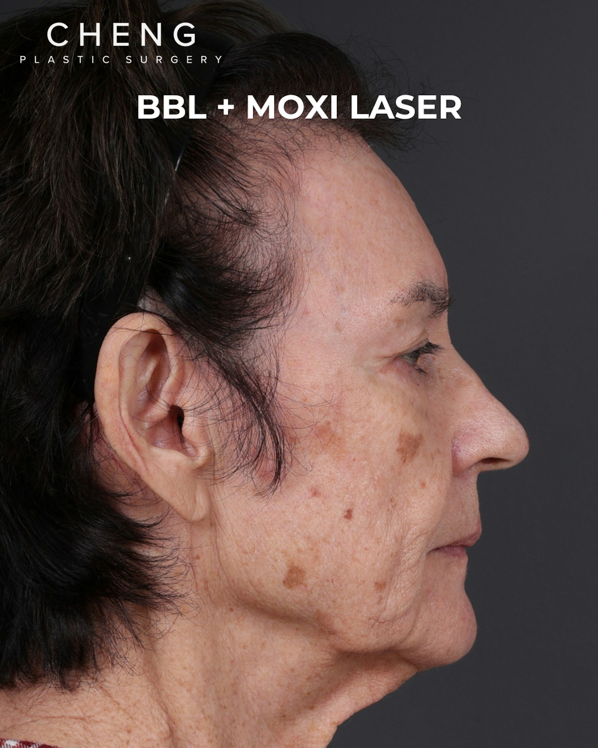 Pigment Laser Before & After Gallery - Patient 182306 - Image 7