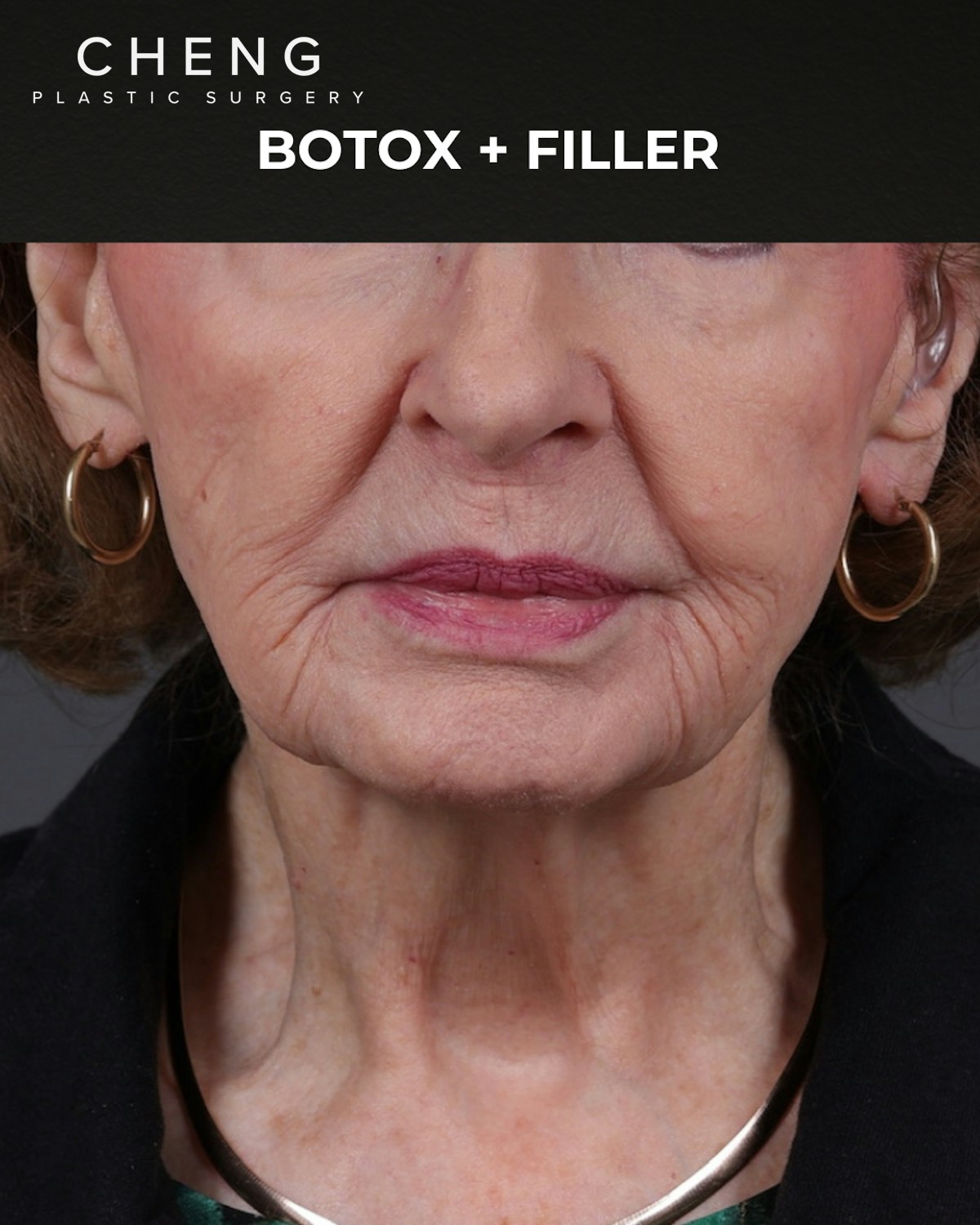 Botox and Dysport Before & After Gallery - Patient 122364 - Image 1