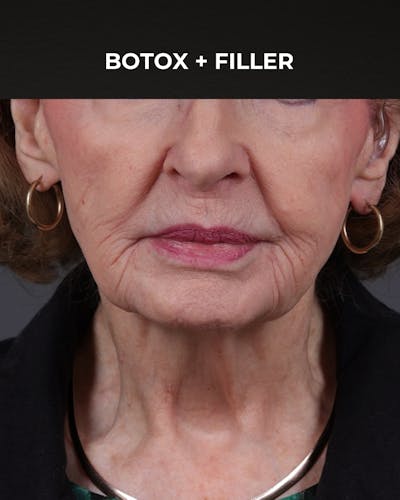 Botox and Dysport Before & After Gallery - Patient 122364 - Image 1