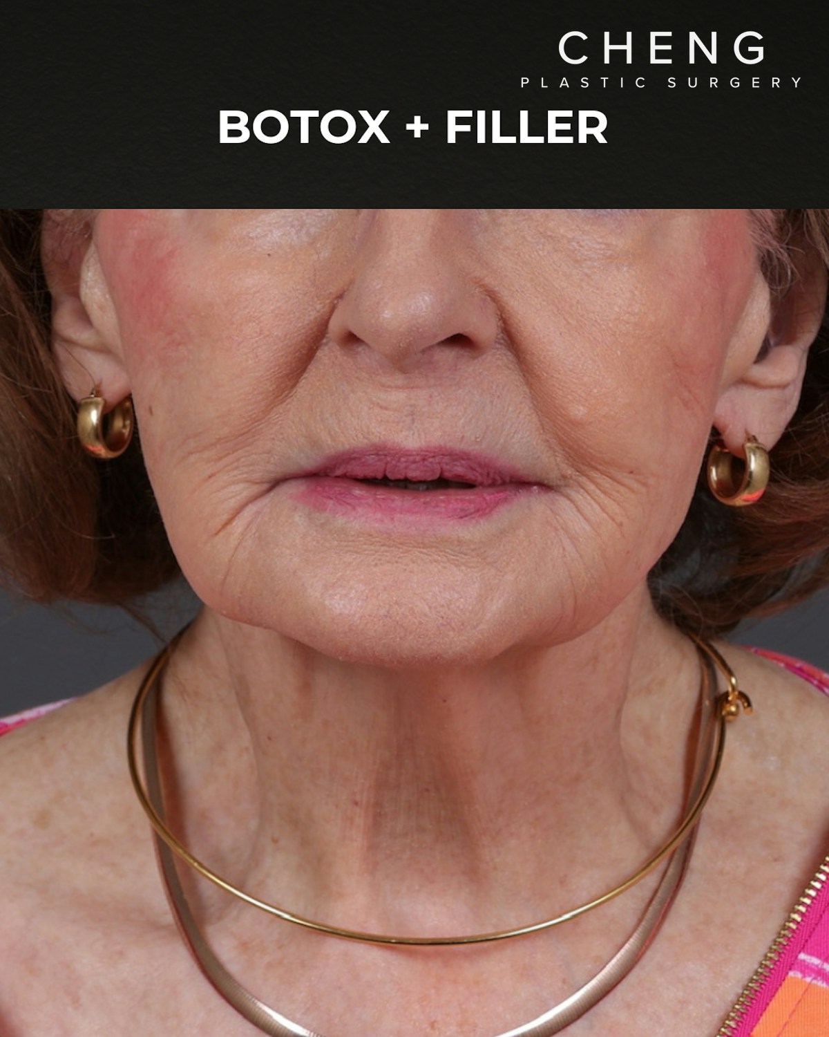 Botox and Dysport Before & After Gallery - Patient 122364 - Image 2