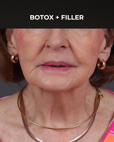 Botox and Dysport Before & After Gallery - Patient 122364 - Image 2