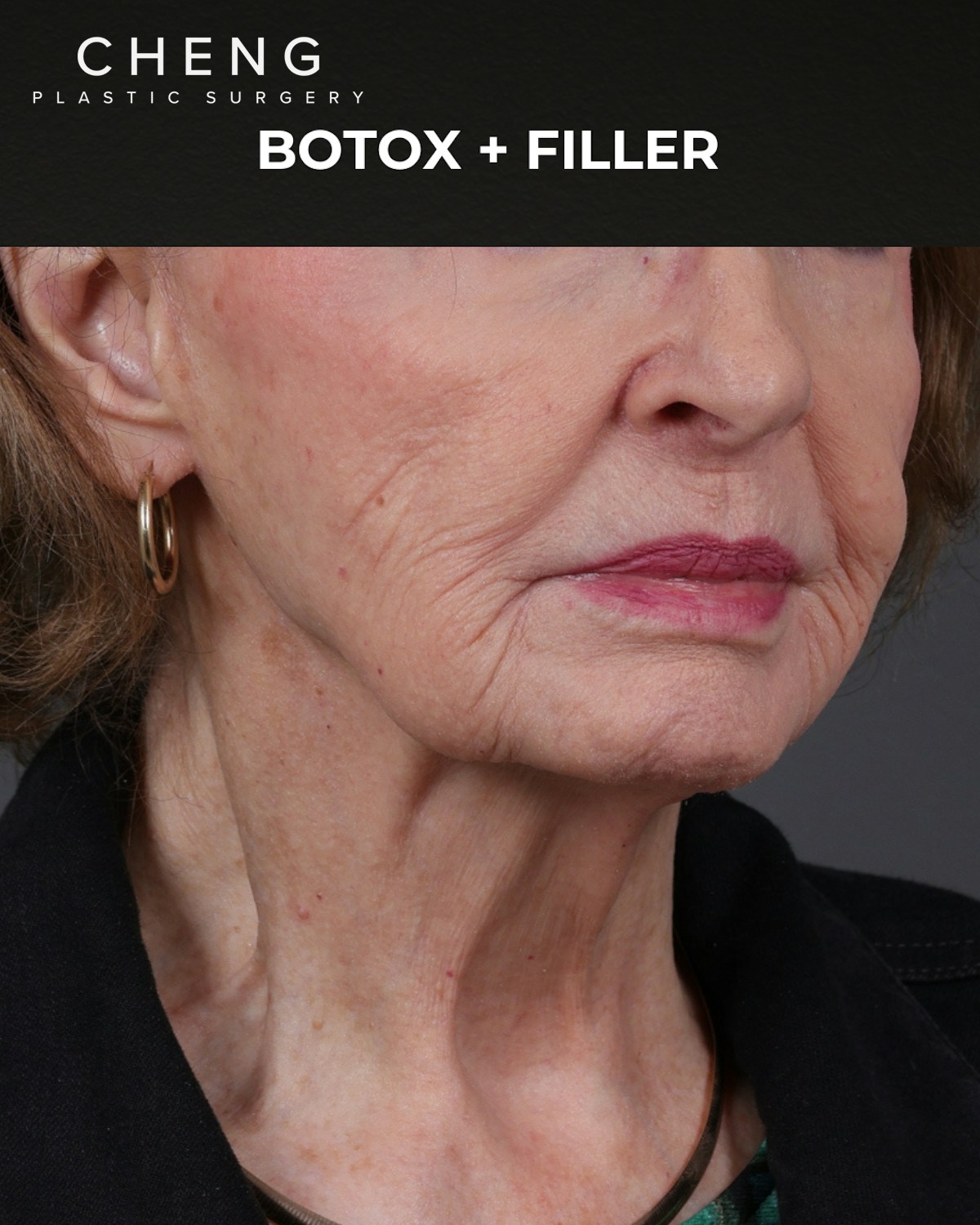 Botox and Dysport Before & After Gallery - Patient 122364 - Image 3