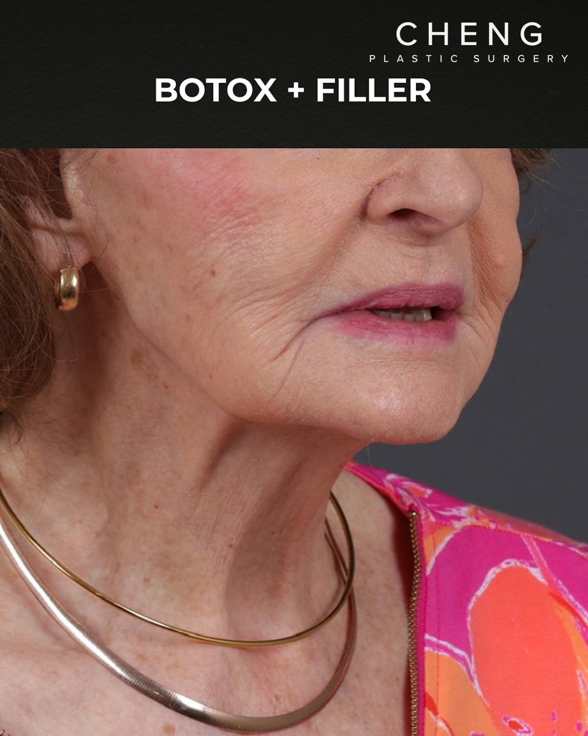 Botox and Dysport Before & After Gallery - Patient 122364 - Image 4