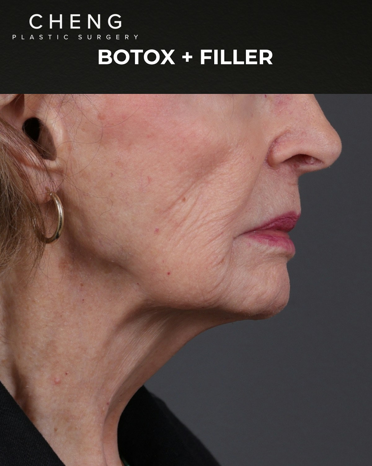 Botox and Dysport Before & After Gallery - Patient 122364 - Image 5