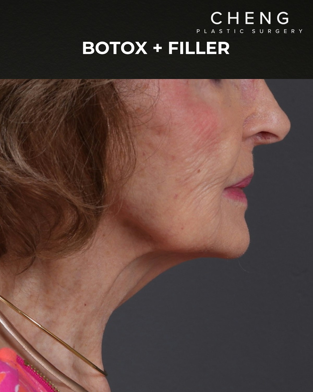Botox and Dysport Before & After Gallery - Patient 122364 - Image 6