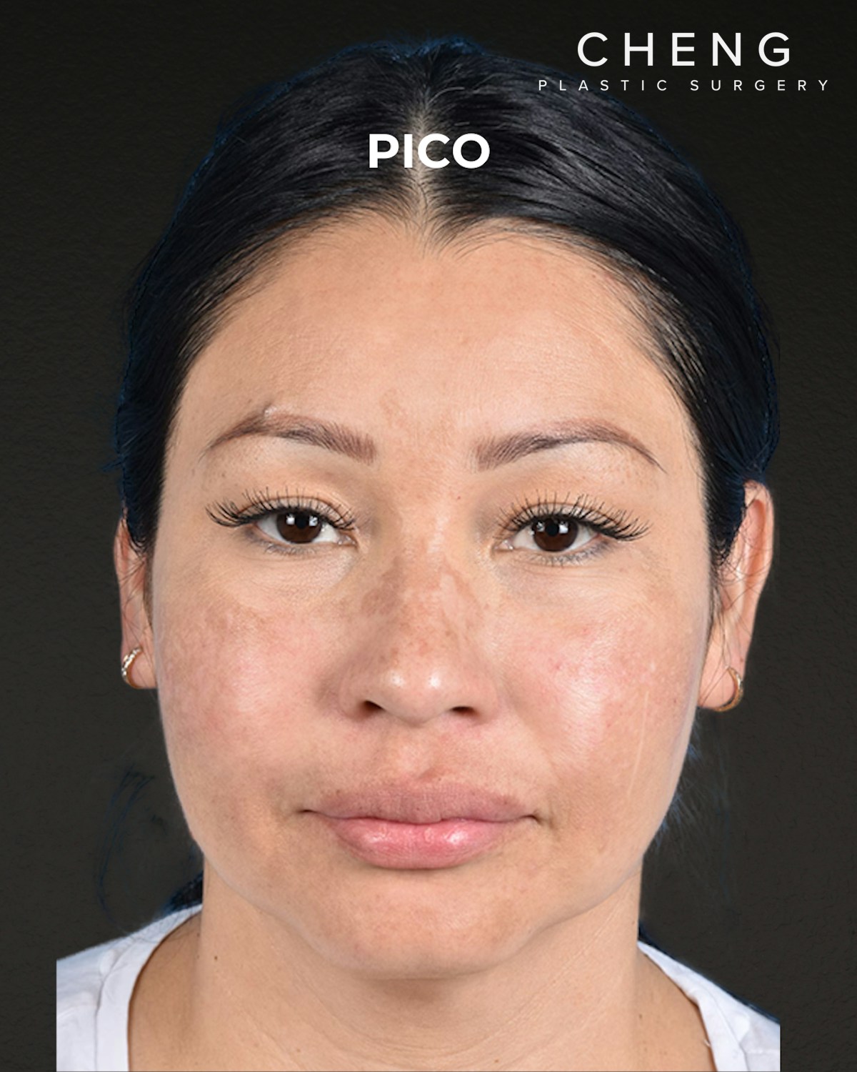 Pigment Laser Before & After Gallery - Patient 555927 - Image 2