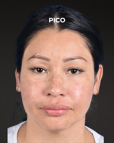 Pigment Laser Before & After Gallery - Patient 555927 - Image 2