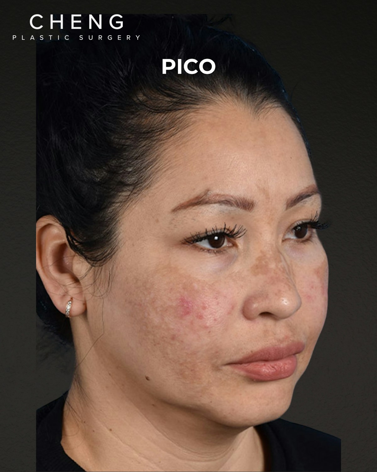 Pigment Laser Before & After Gallery - Patient 555927 - Image 3