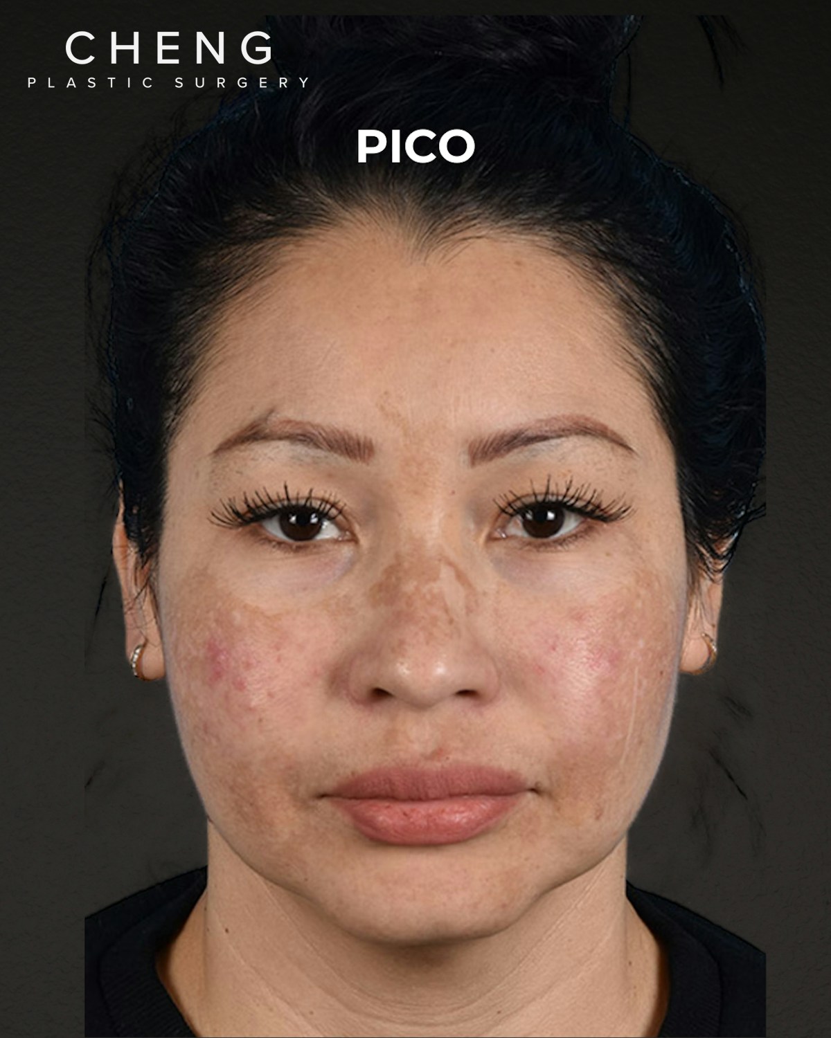 Pigment Laser Before & After Gallery - Patient 555927 - Image 1